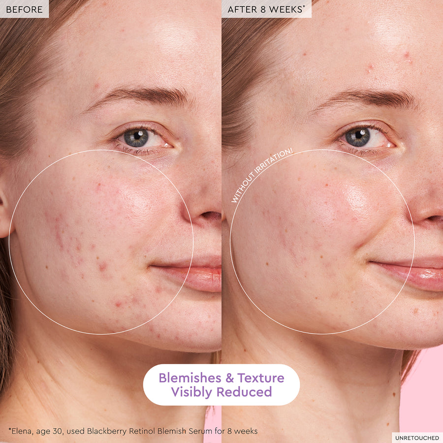 blackberry retinol blemish serum
